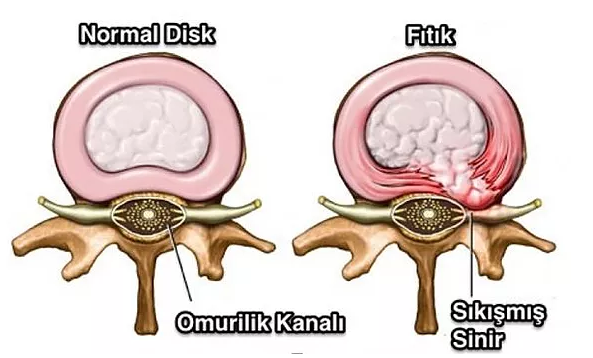 bel fıtıgı teşhisi