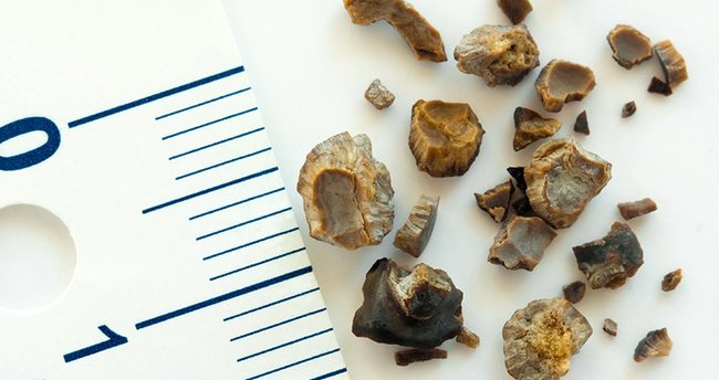 Böbrek Taşı Belirtileri Nelerdir? Böbrek Taşı Nasıl Düşer?