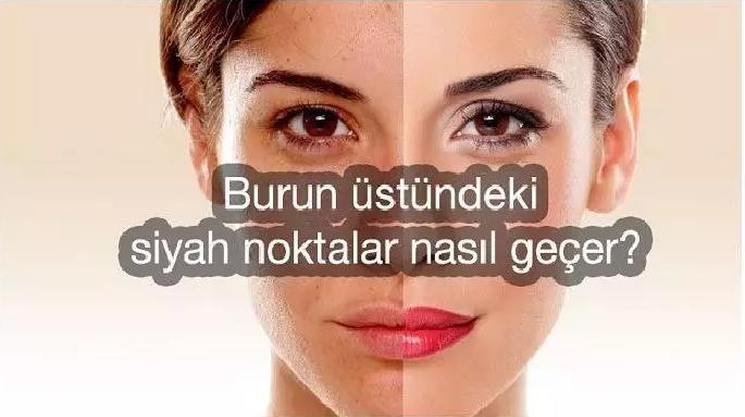 Burun Üstündeki Siyah Noktalar Nasıl Geçer ?