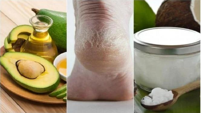 Çatlayan Topuklarınıza Ev Yapımı 5 Doğal Nemlendirici