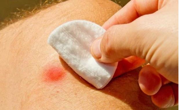 Çıban Nedir ? Çıbandan Kurtulmak için 7 ipucu !