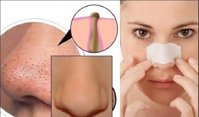 Siyah Noktalara 100 de 100 Kökten Çözüm Maske Tarifleri !