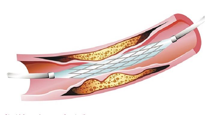 Stent nedir ? nasıl takılır ? Hangi durumlarda uygulanır ?