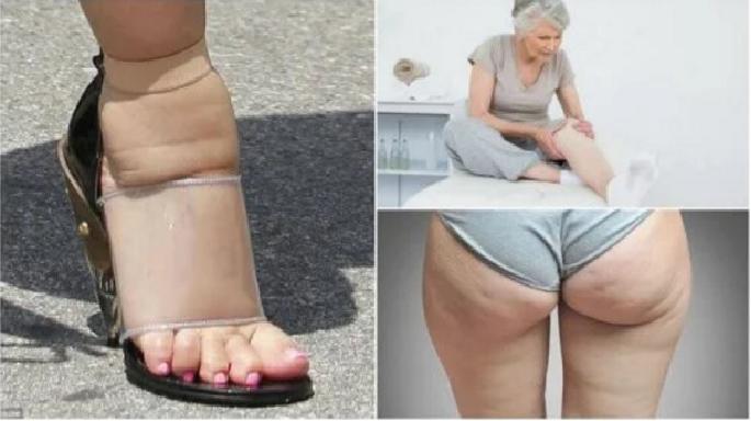 Vücudunuzda Ödem Olduğunu Gösteren 5 Etken !