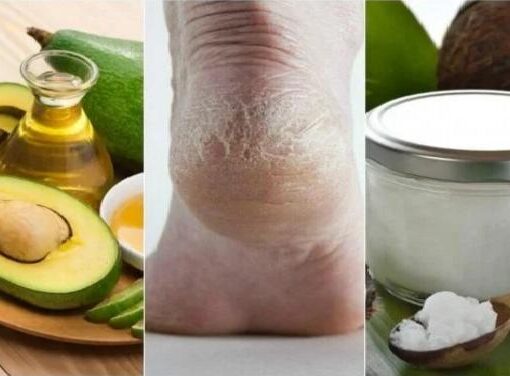 Çatlayan Topuklarınıza Ev Yapımı 5 Doğal Nemlendirici