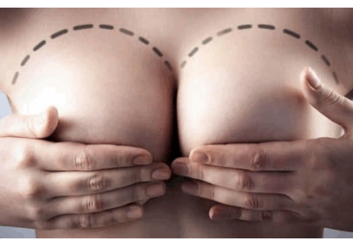 Meme Küçültme Ameliyatı Kime Uygulanır nasıl uygulanır