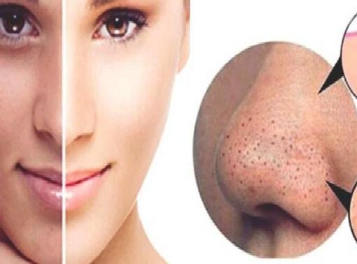 Burundaki Siyah Noktalar için 100 de 100 Doğal Çözümler !