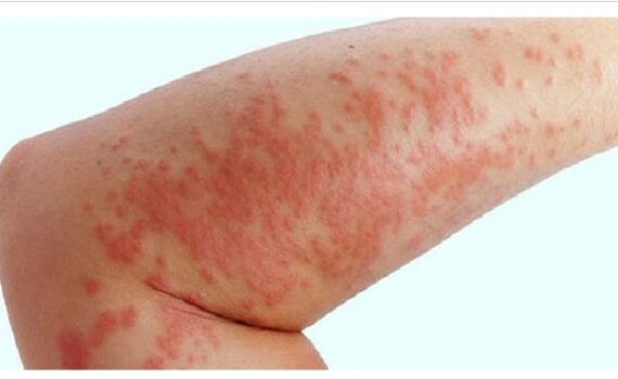 Egzama nedir ? Egzama Neden olur ? Tedavisi !