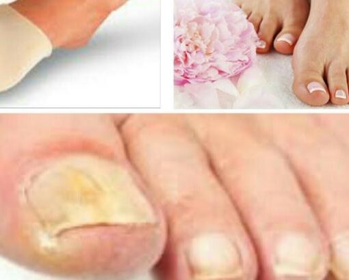 Tırnak Mantarı Tedavisi için 100 de 100 Doğal Çözümler !
