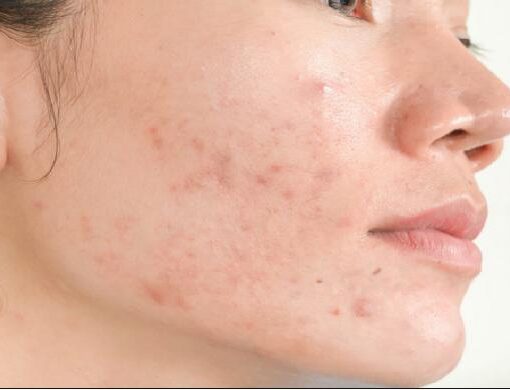 Yüzdeki Lekeler Neden Oluşur ? Yüzdeki Lekelerin Tedavisi !