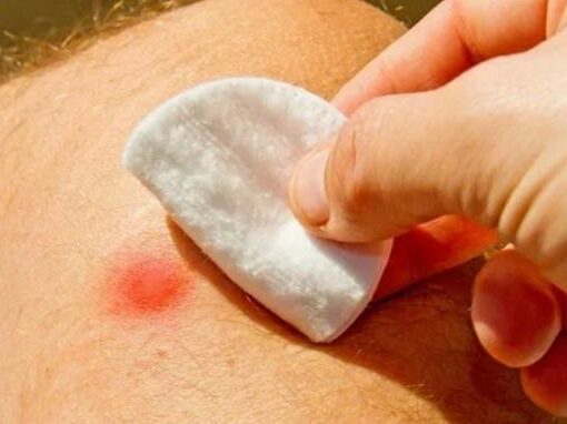 Çıban Nedir ? Çıbandan Kurtulmak için 7 ipucu !